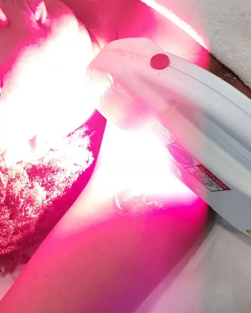 Depilação a laser